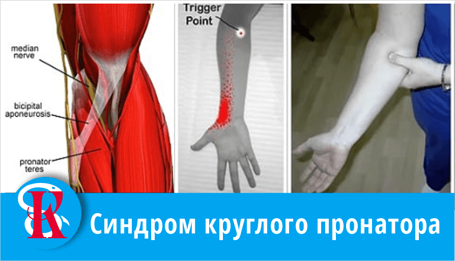 Синдром круглого пронатора