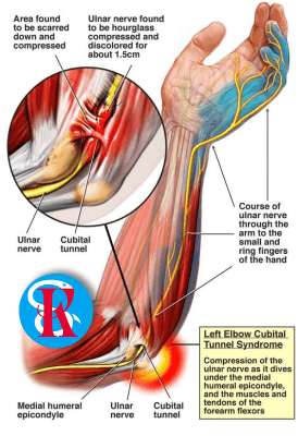 Синдром ліктьового (кубітального) каналу
