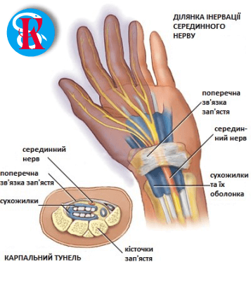 синдром запястного нерва